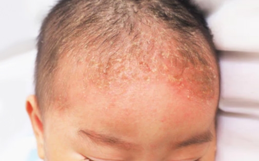 Bebeklerde Konak (Seboreik Dermatit) ve Tedavisi