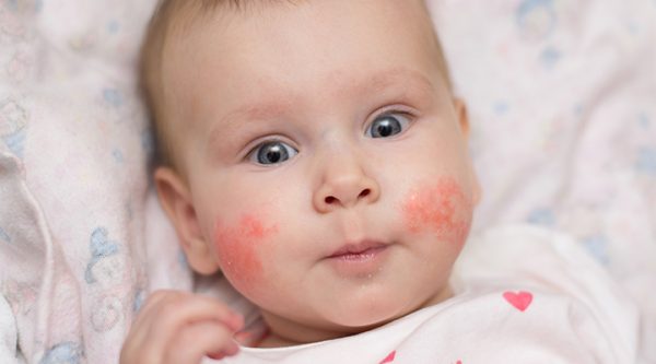 Bebeklerde Süt Alerjisi